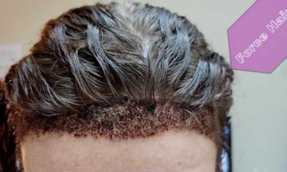 Centrul de implant de par din Turcia Force Hair 