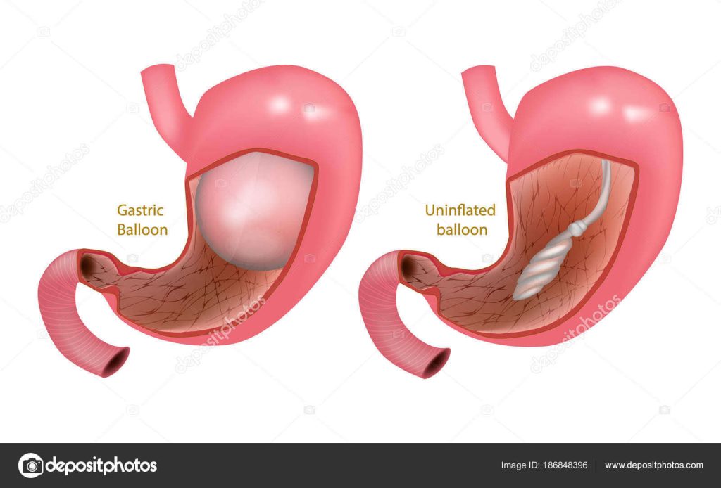Balonul gastric